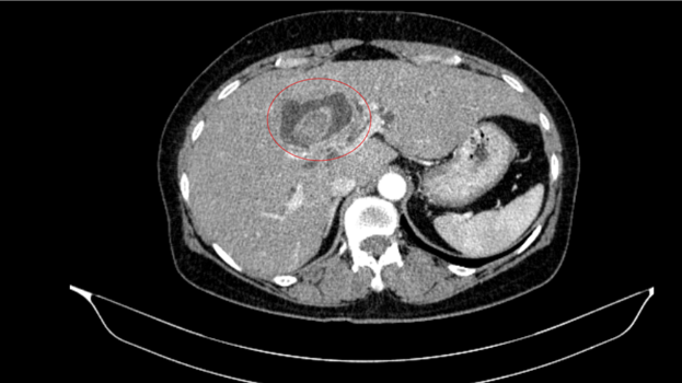 Điều trị thành công bệnh nhân mắc đồng thời hai ung thư nguyên phát 