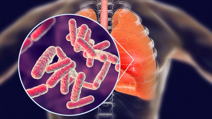 Gần 40% bệnh nhân mắc lao bị bỏ sót vì không có triệu chứng