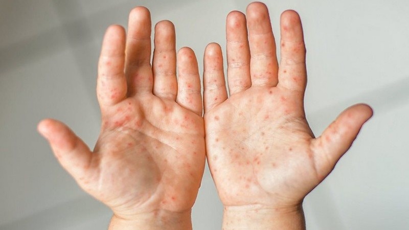 Hà Nội ghi nhận 5 ổ dịch tay chân miệng