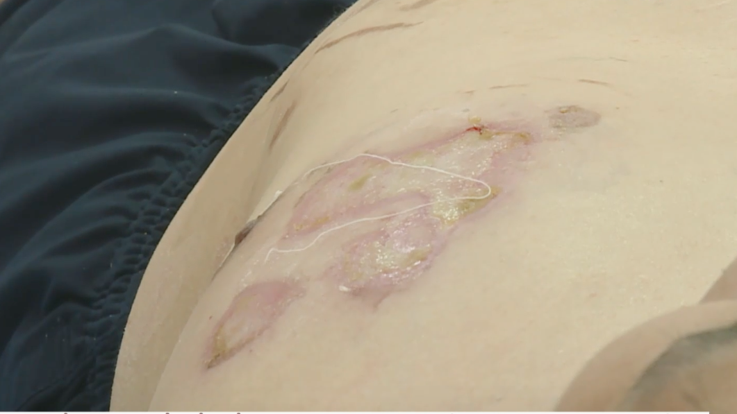 Nhiều người bị bỏng vì hóa chất thông tắc cống