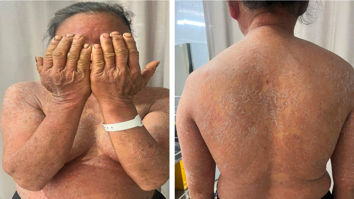 Đừng biến bệnh nấm da thành 'thảm họa' vì thuốc bôi không rõ loại