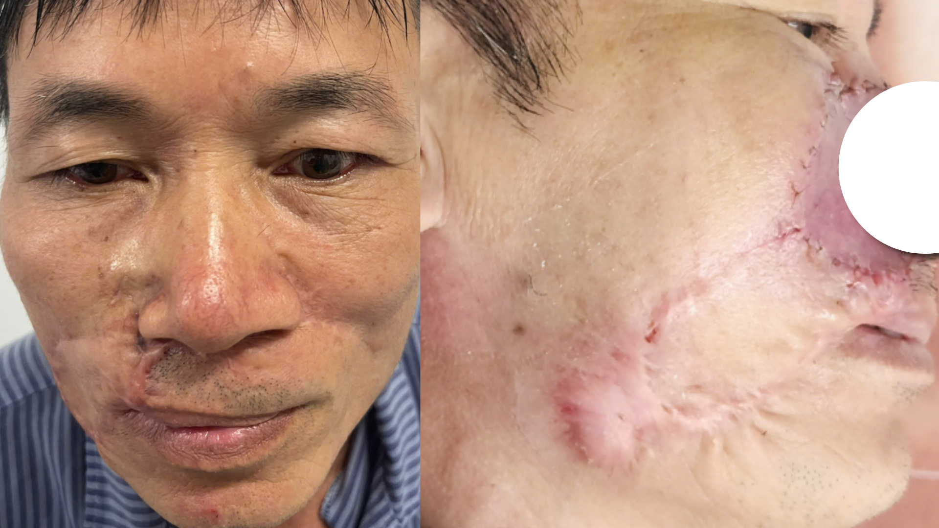 Ung thư biểu mô tế bào đáy tái phát: Khi 'mổ đi mổ lại' vẫn không hết bệnh