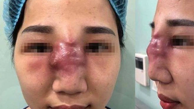 Mỗi năm Việt Nam có 25.000-35.000 ca biến chứng thẩm mỹ