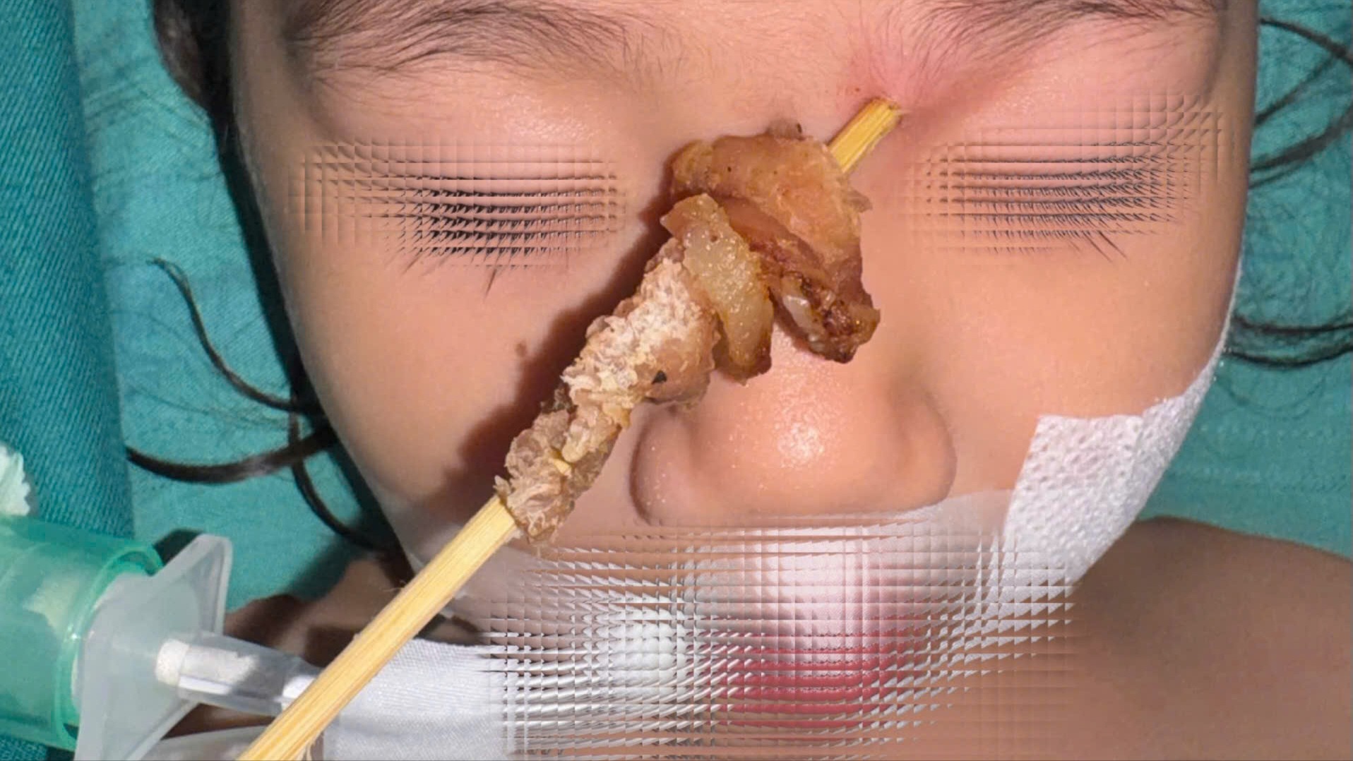 Cứu bé gái bị que xiên thịt đâm suýt vỡ nhãn cầu