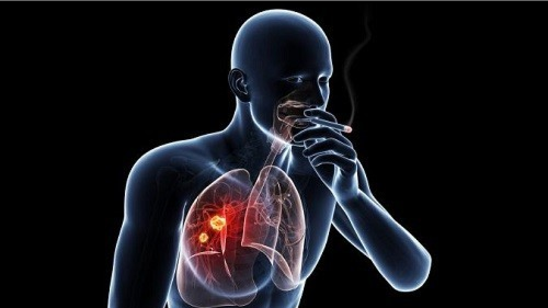 Ung thư đầu cổ có liên quan trực tiếp đến thuốc lá