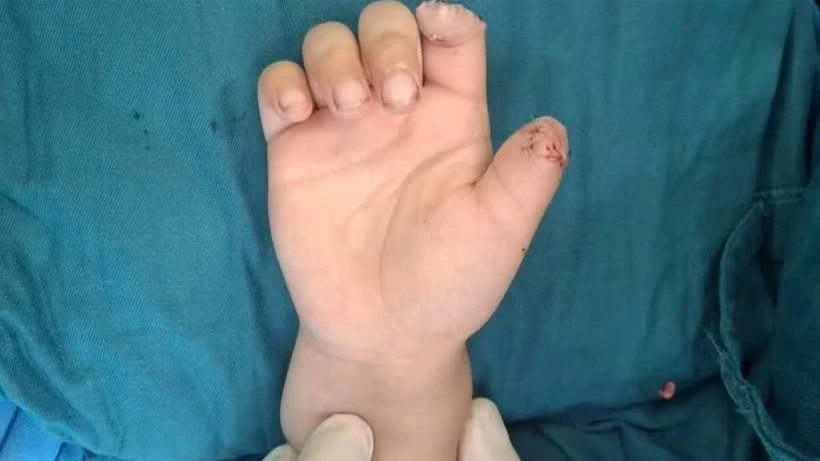 Tai nạn xe điện tự chế, bé 5 tuổi đứt lìa hai ngón tay