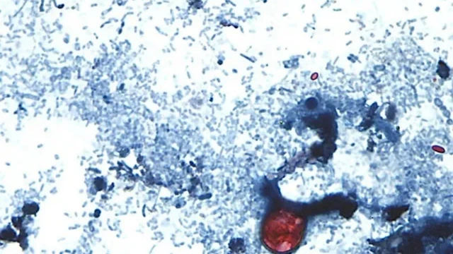 Mỹ giám sát chặt chẽ đợt bùng phát dịch bệnh vi khuẩn Cyclospora