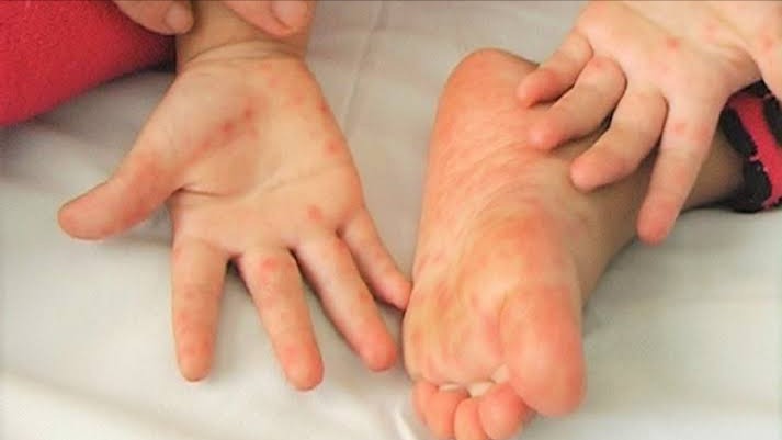 Tay chân miệng vào mùa, dù có vaccine, vẫn không thể chủ quan