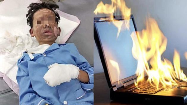 Bé trai 8 tuổi bỏng nặng do laptop phát nổ