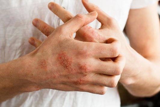 Bệnh ngoài da hay gặp vào mùa đông và cách hạn chế