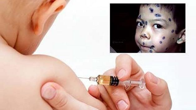 Tiêm vắc xin thủy đậu thế nào để tránh biến chứng?