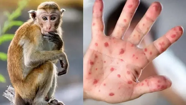 Campuchia ghi nhận thêm ba ca mắc bệnh đậu mùa khỉ