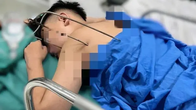 Cứu sống nam thanh niên bị dị vật đâm thấu tim