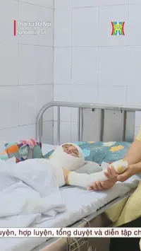 Gia tăng tai nạn bỏng ở trẻ trong dịp hè